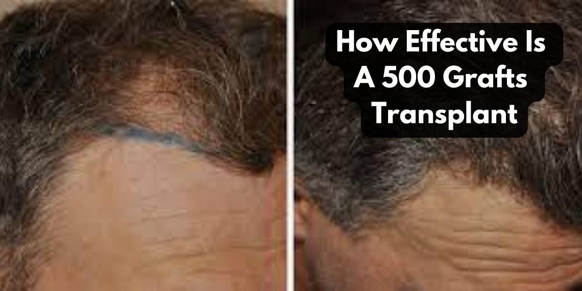 How Effective Is A 500 Grafts Transplant