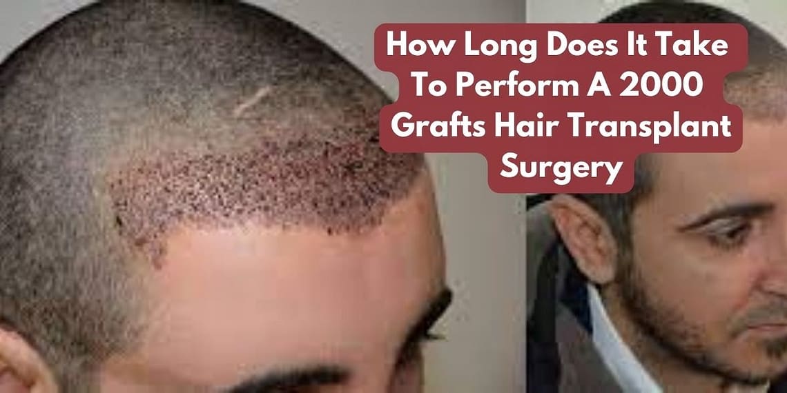 How Long Does It Take To Perform A 2000 Grafts Hair Transplant Surgery