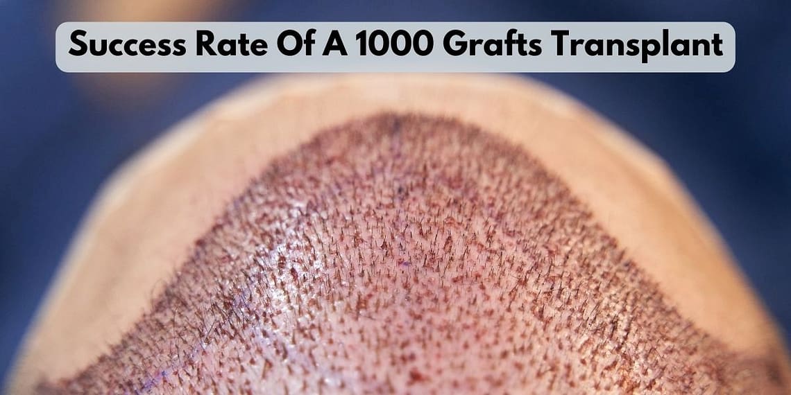 What Is The Success Rate Of A 1000 Grafts Transplant